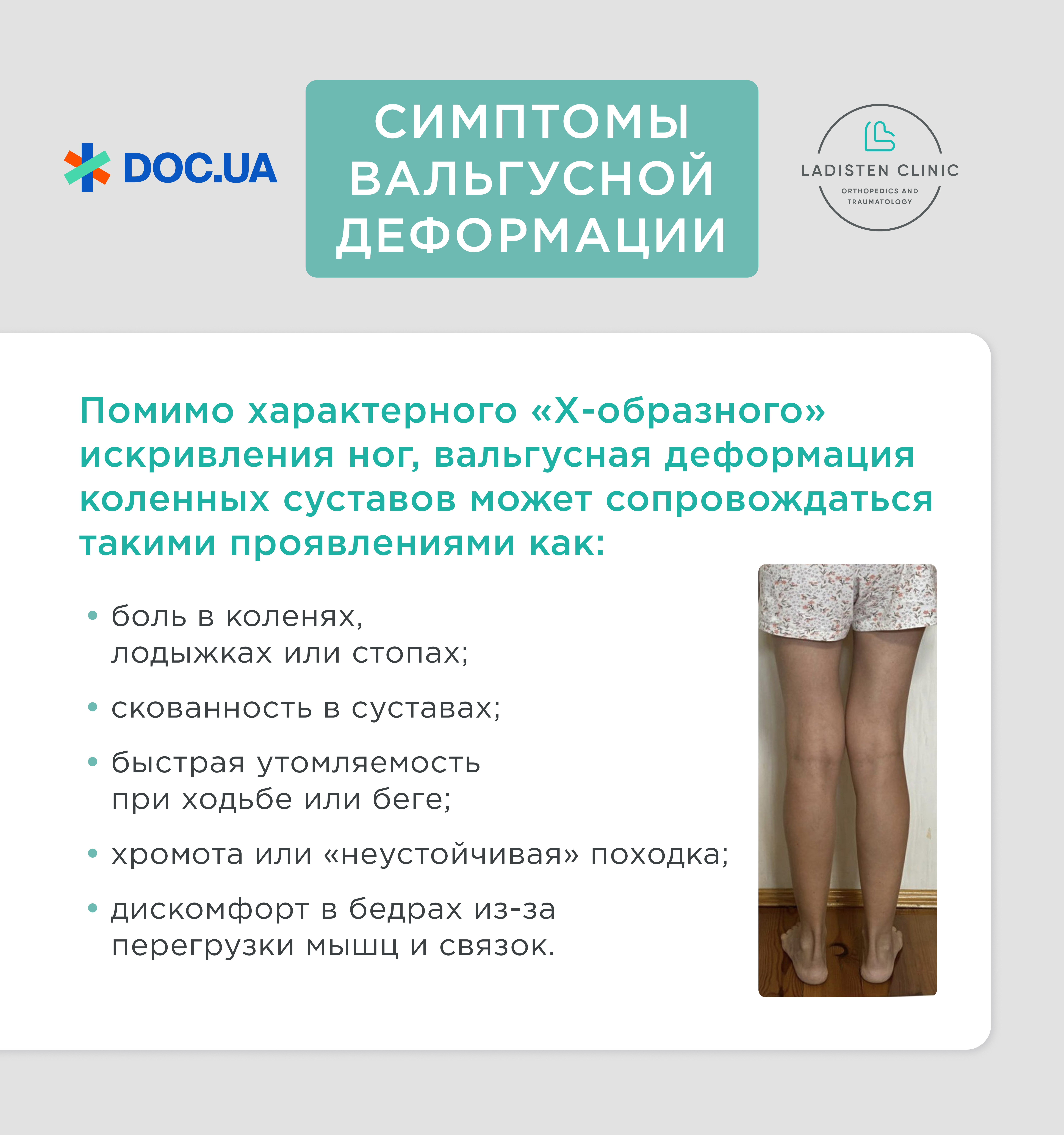 Симптомы вальгусной деформации