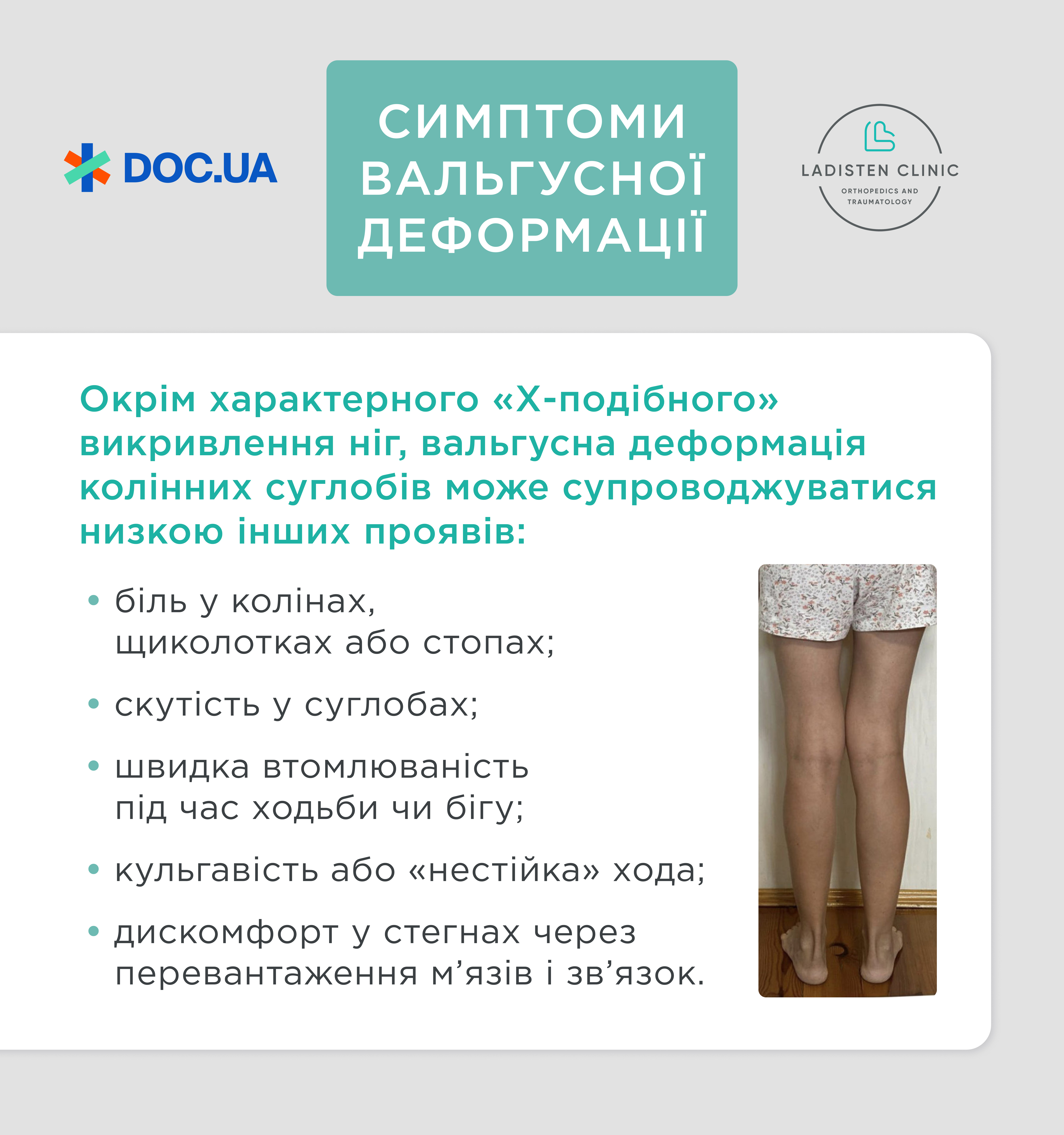 Симптоми вальгусної деформації